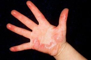 Picture of a burn on the hand