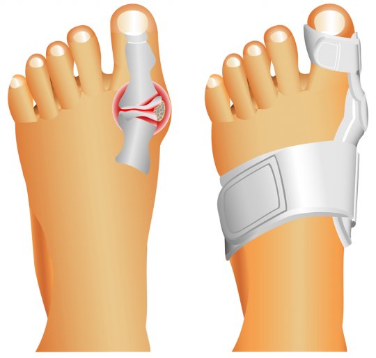 Метод лечения косточки пальца на ноге