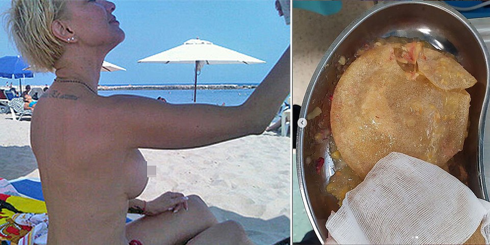 Слева: снимок прекрасного бюста Леры как-то опубликовал в соцсетях Сергей Лазарев. Справа: ужасающей фотографией своих удаленных имплантов в Инстаграме поделилась сама Лера. 